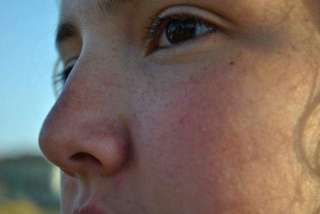 Increased UV exposure triggers melanin production, resulting in more freckles. - Photo: Paulina Spencer (Flickr)