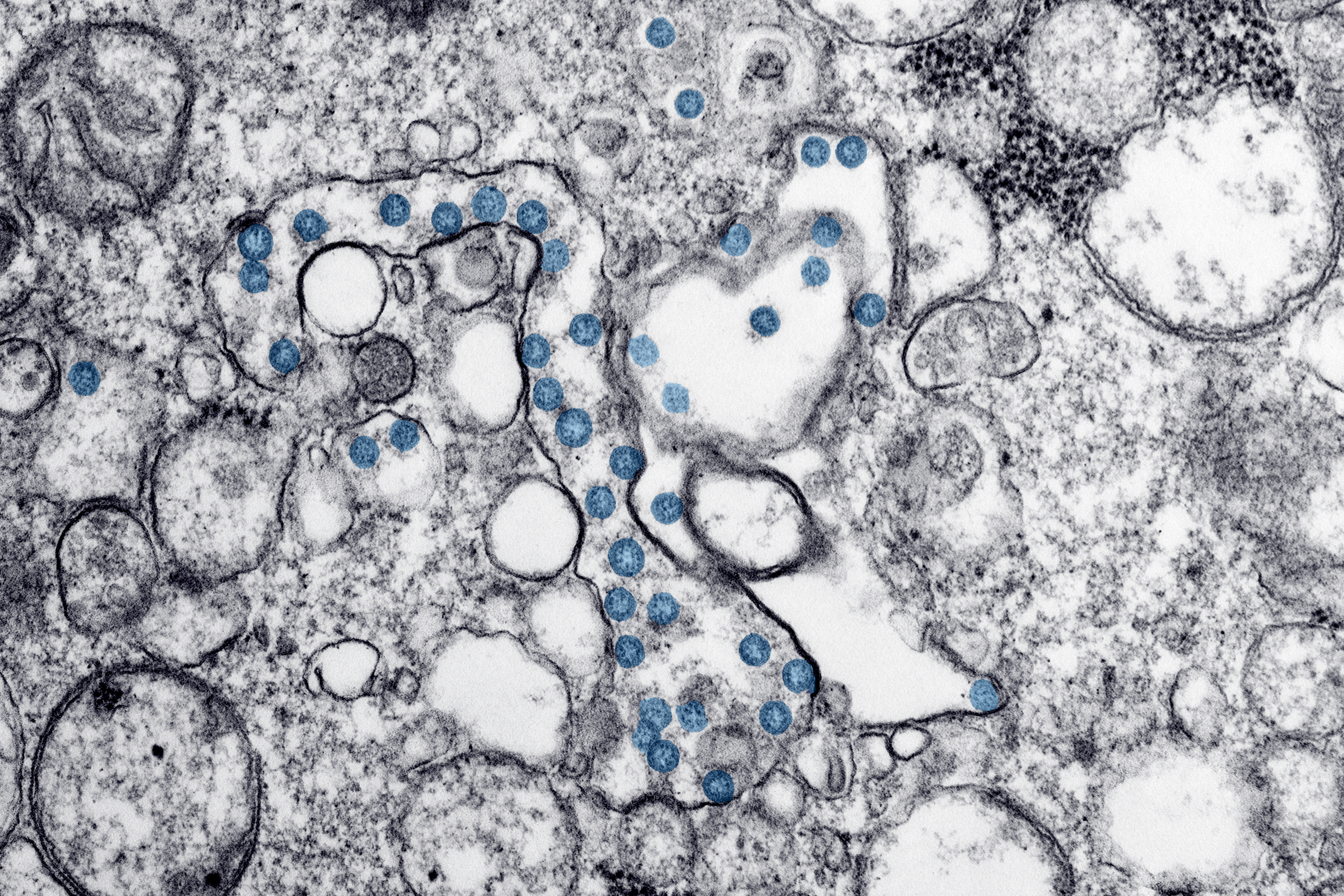 Transmission electron microscopic image of an isolate from the first U.S. case of COVID-19, formerly known as 2019-nCoV. The spherical viral particles, colorized blue, contain cross-section through the viral genome, seen as black dots.