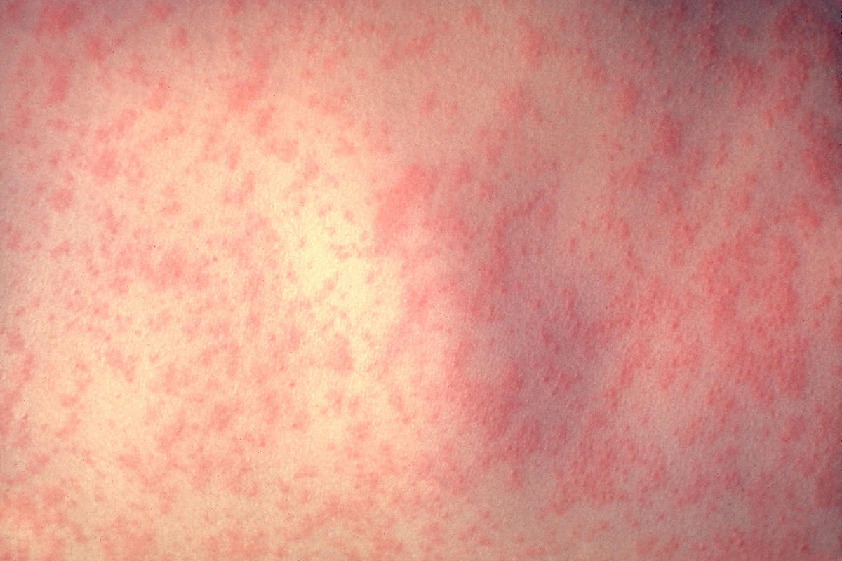 A rash forms on a person with measles