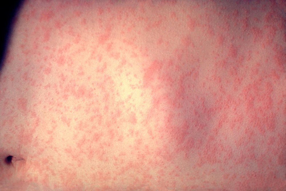 Skin of a patient with 3 days of measles infection