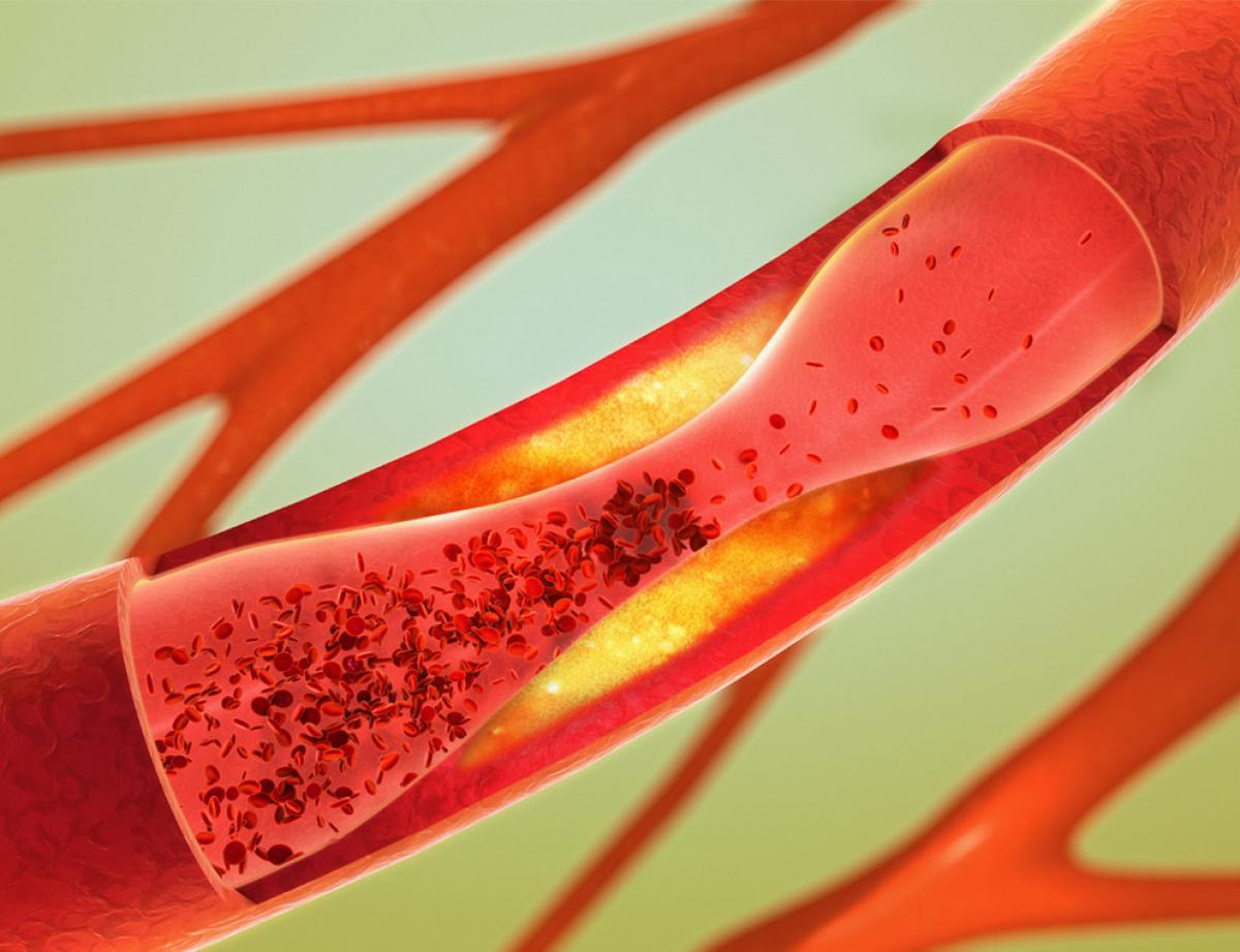An artistic rendering of blood flowing through an artery, slowed down by cholesterol buildup