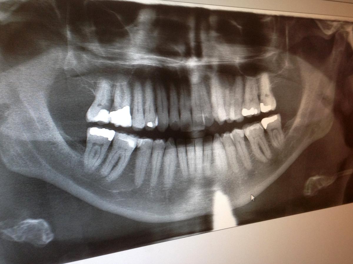 An x-ray of a mouth with crowns and teeth fillings showing up as solid masses