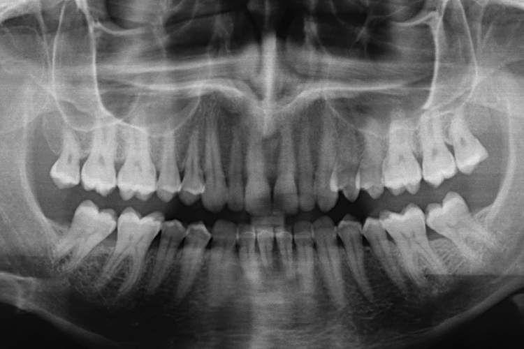 X-ray image of full set of adult teeth