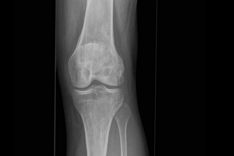 X-ray image of a human knee joint