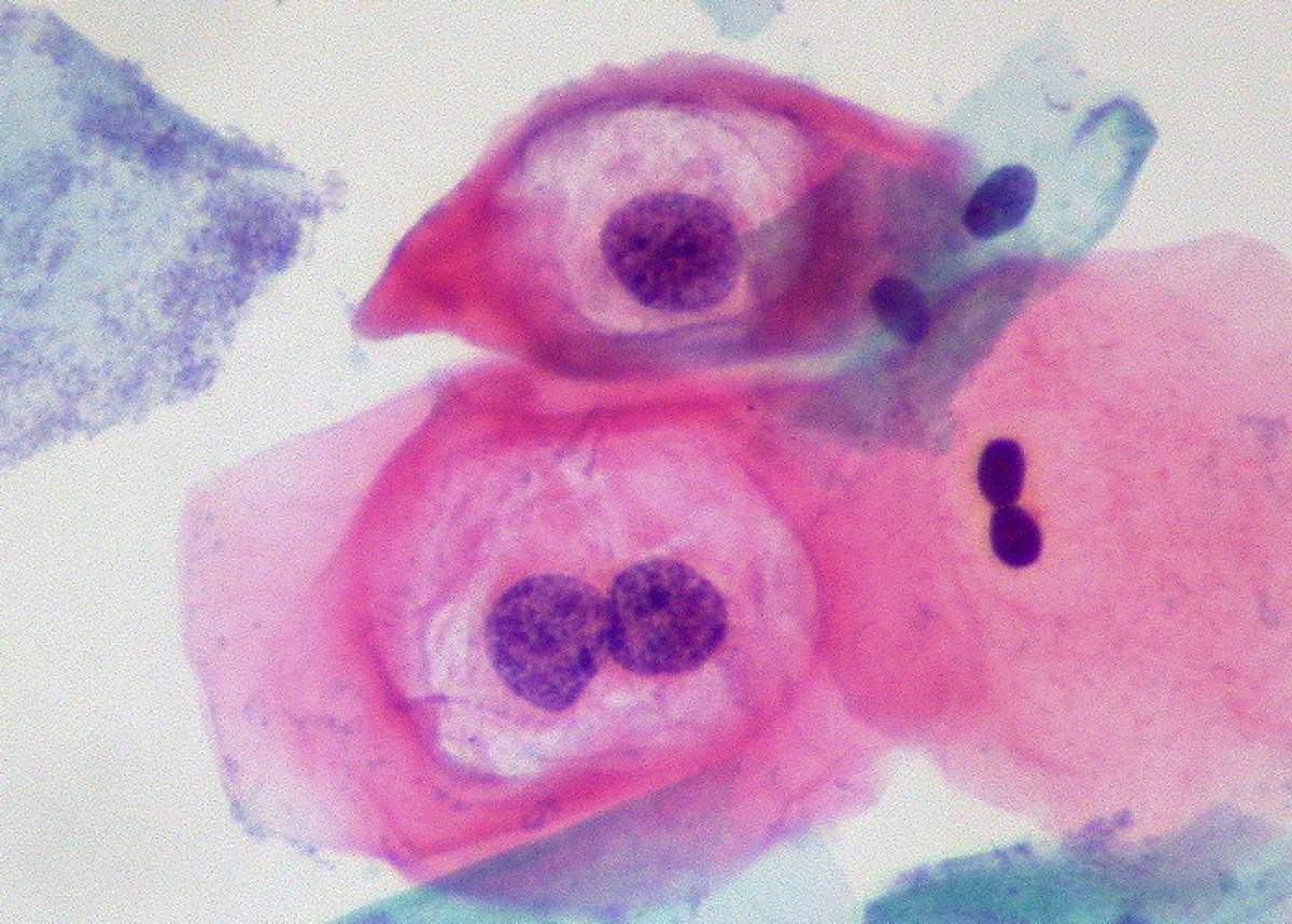 Microscope slide showing cancerous cells from the cervix.