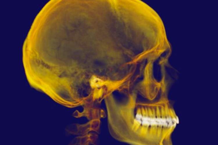 A false-color skull x-ray