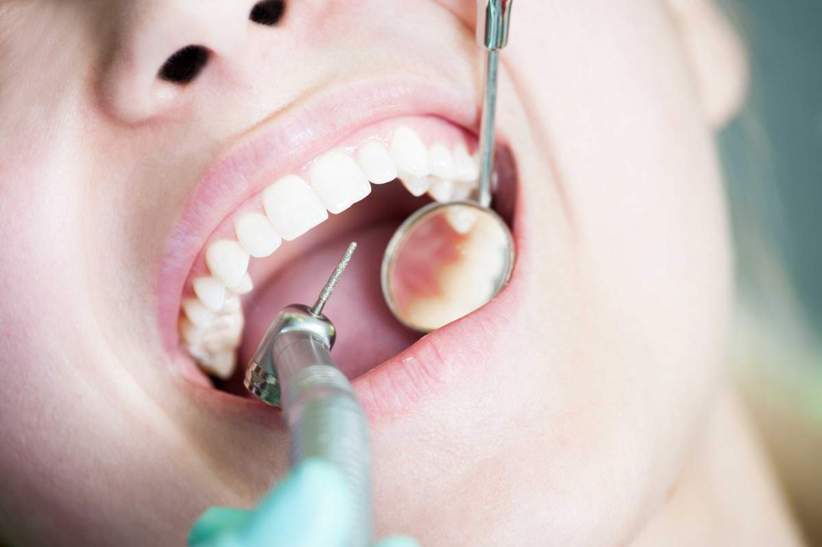 closeup of mouth during dental cleaning