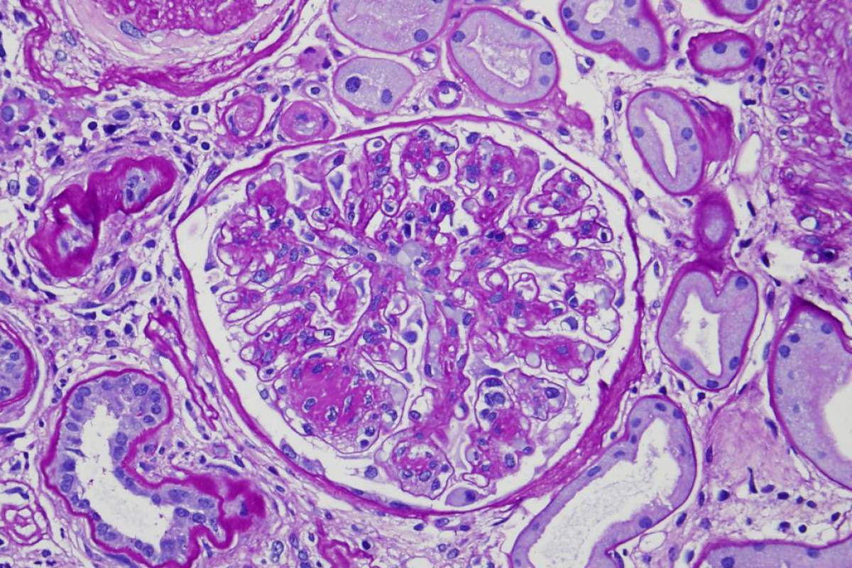 image of a kidney cell with diabetic nephropathy