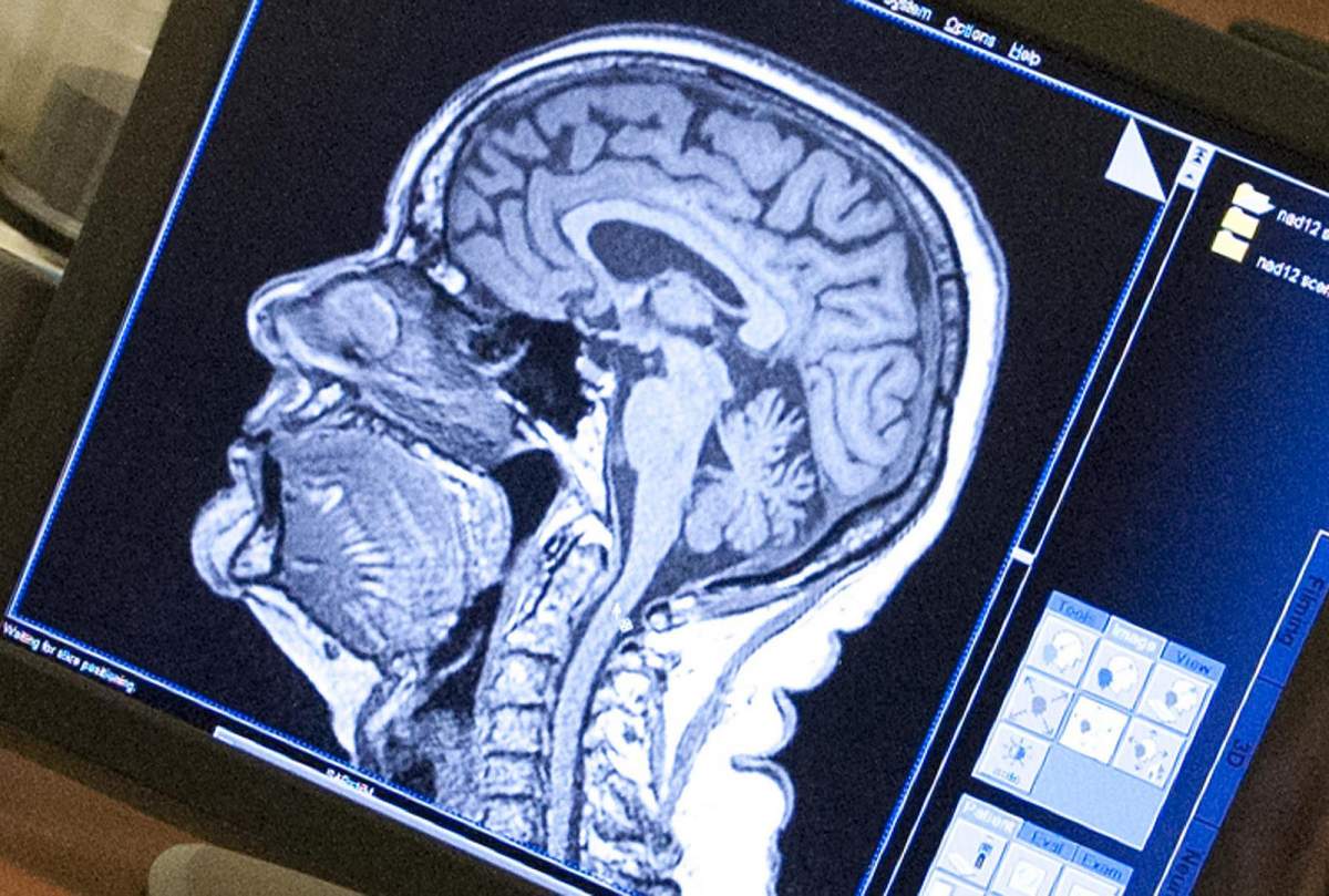 An image of an MRI scan on a desktop computer monitor.
