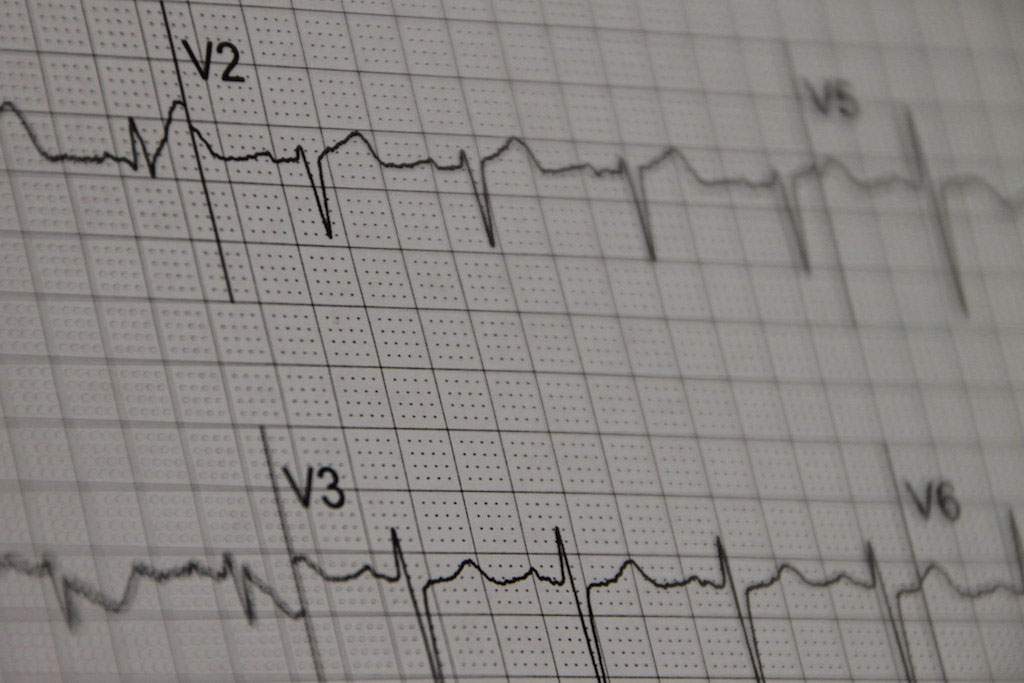 An EKG print out (mgstanton, Flickr).