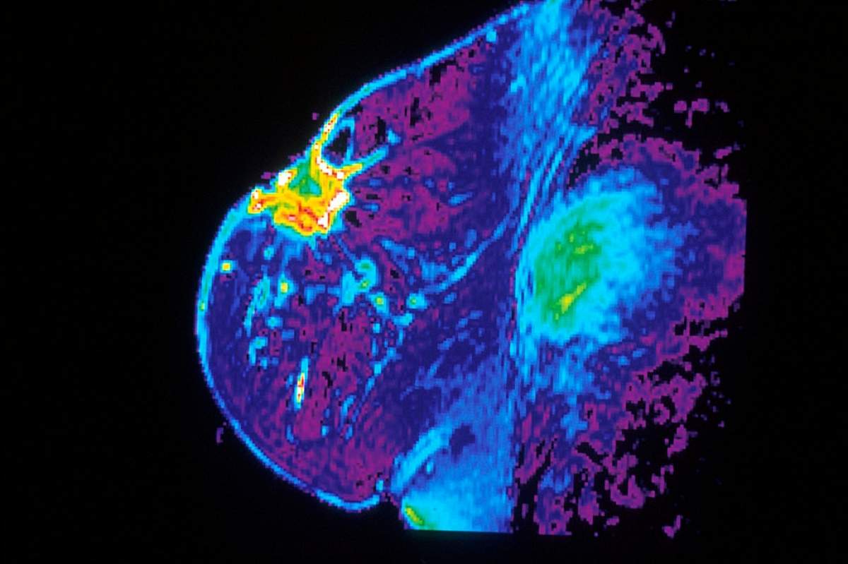 Color-enhancement showing magnetic resonance image of an individual breast (Dr. Steven Harmes/National Institutes of Health, Wikimedia Commons).