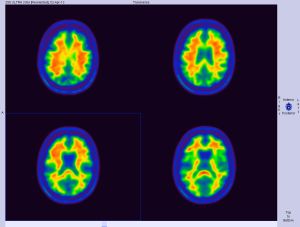 Four slices of normal brain scans show up on a colorful MRI display
